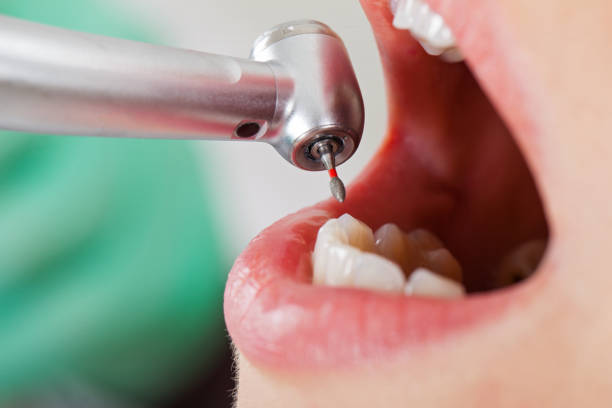 Best Emergency Wisdom Teeth Removal in Pleasant Garden, NC